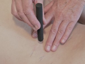 Acupunctuur Alkmaar moxa therapie